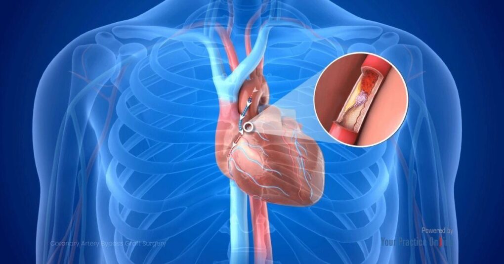 Koroner Bypass veya Stent Sonrası “Motoru Sıfırladık” Zannetmeyin!